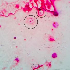 Hallazgo de blastosporas en tinción de Gram del LCR.
