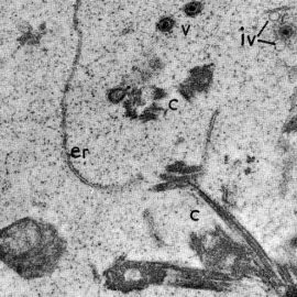Virus Epstein Barr: primer oncovirus humano descubierto y su relación con el desarrollo de enfermedades hematooncológicas como el Linfoma de Burkitt.